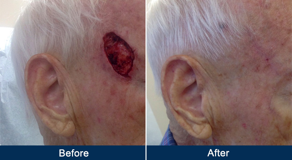 Acne In Hair >> Mohs Surgery - Metropolitan Dermatology Acne In Hair >> Mohs Surgery - Metropolitan Dermatology