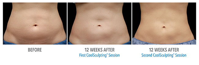 Coolsculpting Before Afters